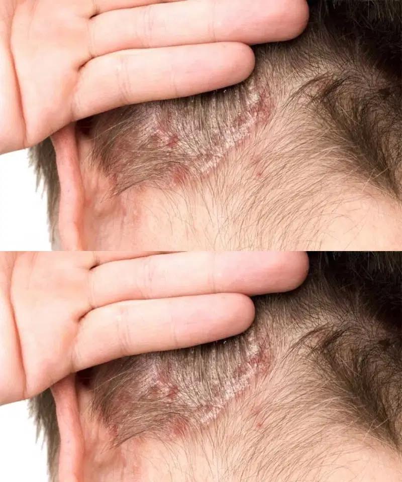 A Parent’s Guide to Understanding Scalp Bumps and Psoriasis in Children